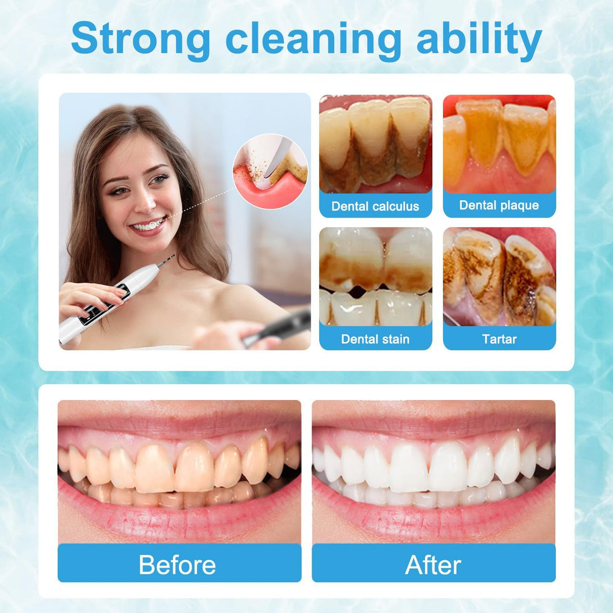 Ultrasonic Dental Plaque Remover